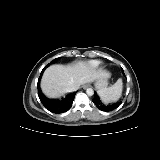 Acute appendicitis and COVID 19 pneumonia (Radiopaedia 76604-88380 Axial C+ portal venous phase 9).jpg