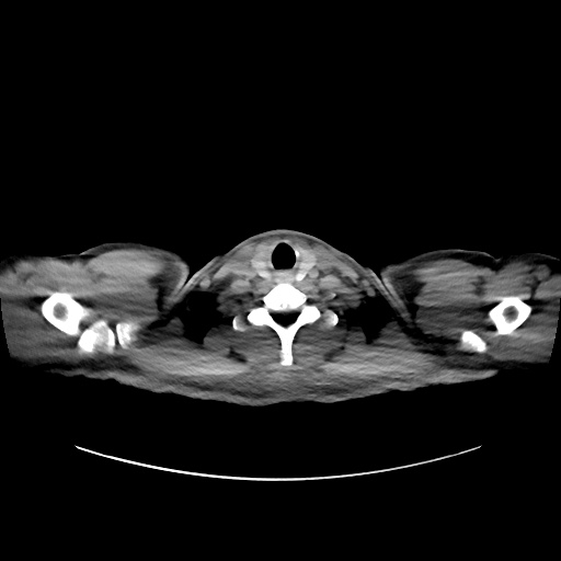 File:Acute appendicitis and COVID 19 pneumonia (Radiopaedia 76604-88380 Axial non-contrast 1).jpg