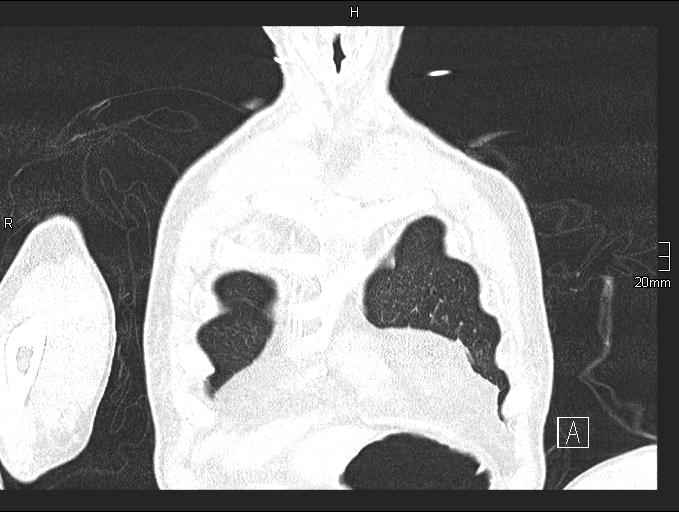 Acute aspiration pneumonitis (Radiopaedia 55642-62166 Coronal lung window 11).jpg