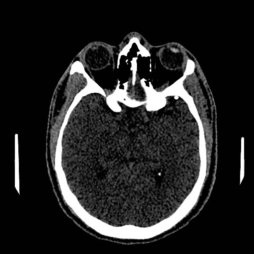 Acute basilar artery occlusion (Radiopaedia 43582-46985 Axial non-contrast 84).jpg