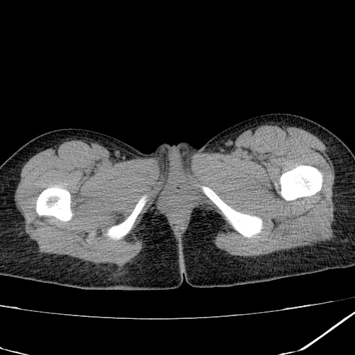 Acute bilateral pyelonephritis (Radiopaedia 74153-84969 Axial non-contrast 55).jpg
