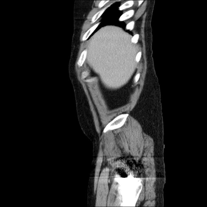 Acute cholecystitis and incidental left sided IVC (Radiopaedia 49352-54459 Sagittal C+ portal venous phase 79).jpg