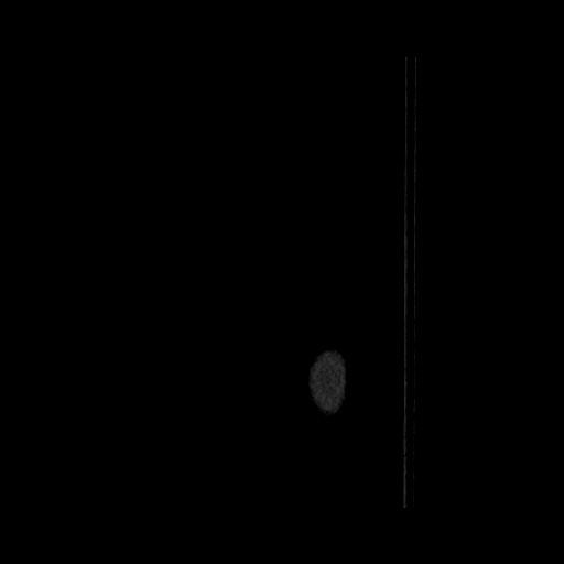 Acute cholecystitis with tensile fundus sign (Radiopaedia 71394-81723 Sagittal non-contrast 2).jpg