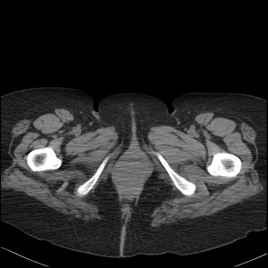 Acute colonic hemorrhage in ulcerative colitis (Radiopaedia 77415-89538 Axial non-contrast 148).jpg