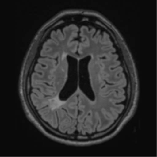 Acute disseminated encephalomyelitis (ADEM)- Anti-NMDA receptor encephalitis (Radiopaedia 54920-61201 Axial FLAIR 42).png