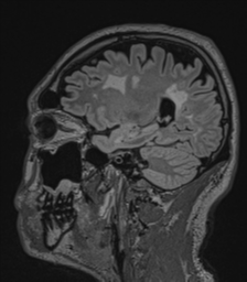 Acute disseminated encephalomyelitis (ADEM)- Anti-NMDA receptor encephalitis (Radiopaedia 54920-61201 Sagittal FLAIR 57).png