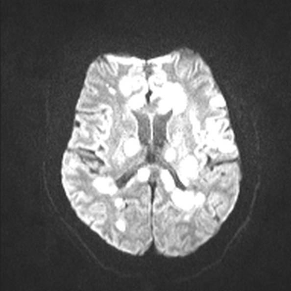 Acute disseminated encephalomyelitis (Radiopaedia 37253-39033 Axial DWI 43).jpg