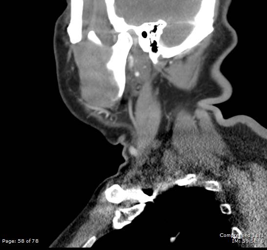 Acute epiglottitis (Radiopaedia 54375-60590 Sagittal C+ arterial phase 58).jpg