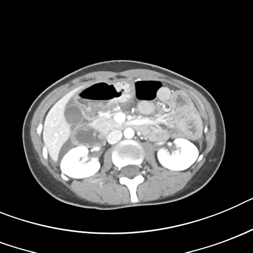 Acute gangrenous appendicitis with perforation (Radiopaedia 40152-42662 Axial C+ portal venous phase 27).png