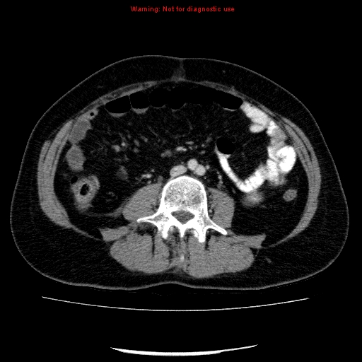Acute gangrenous cholecystitis (Radiopaedia 10123-10661 Axial C+ portal venous phase 60).jpg