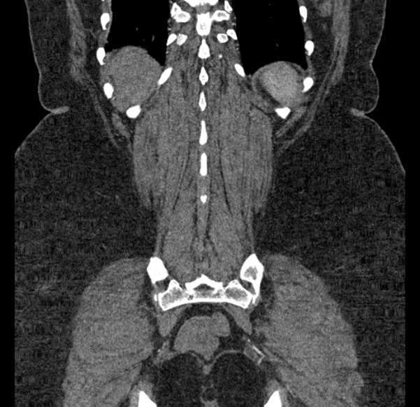 Acute mesenteric ischemia (Radiopaedia 80029-93316 Coronal C+ arterial phase 122).jpg