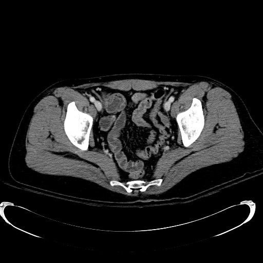 Acute myocardial infarction in CT (Radiopaedia 39947-42415 Axial C+ portal venous phase 117).jpg
