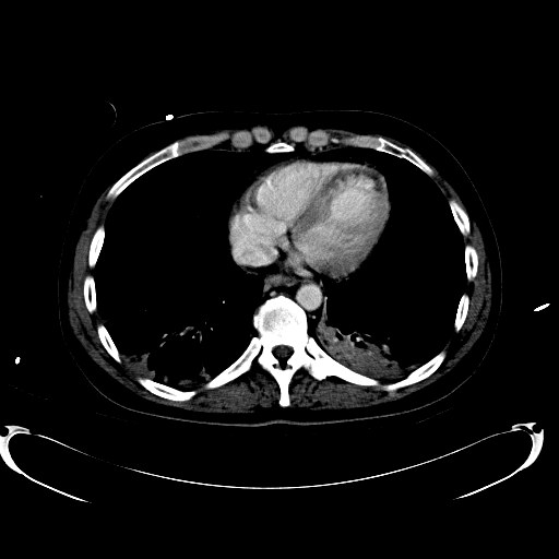 File:Acute myocardial infarction in CT (Radiopaedia 39947-42457 Axial C+ portal venous phase 7).jpg