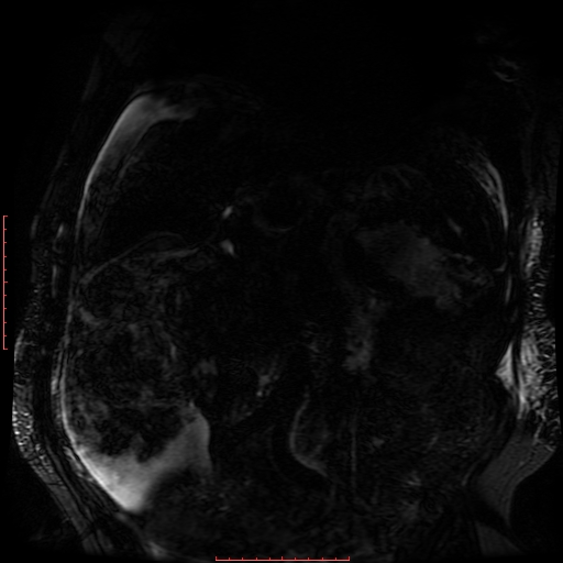 Acute necrotizing pancreatitis (Radiopaedia 28194-28448 Coronal MRCP 48).jpg