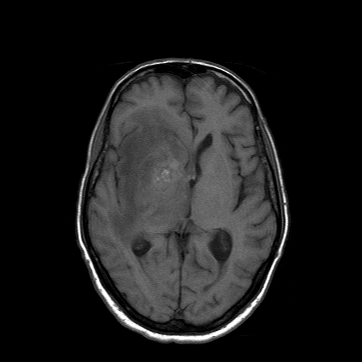 File:Acute necrotizing toxoplasma encephalitis (Radiopaedia 10683-11149 Axial T1 9).jpg