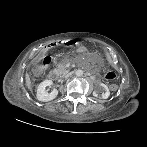Acute on chronic pancreatitis (Radiopaedia 13233-13244 Axial C+ portal venous phase 46).jpg