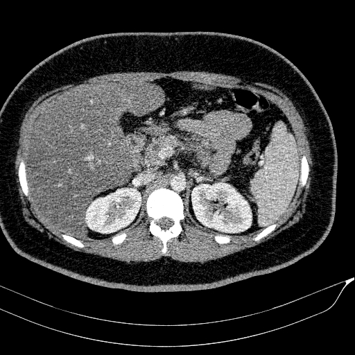 Acute on chronic pancreatitis (Radiopaedia 80902-94423 Axial C+ portal venous phase 55).jpg