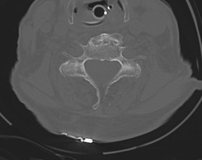 Acute on chronic subdural hematoma and thoracic vertebral injury in a multitrauma patient (Radiopaedia 31698-32619 Axial bone window 39).jpg
