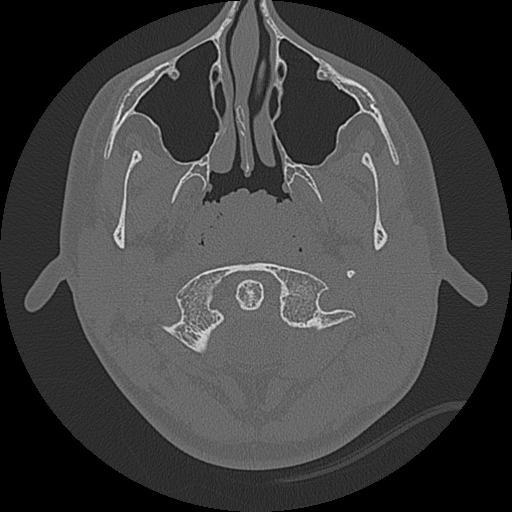 Acute otomastoiditis and Bezold abscess (Radiopaedia 88184-104786 Axial bone window 1).jpg
