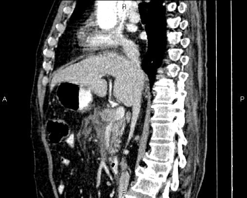 Acute pancreatitis (Radiopaedia 85146-100701 Sagittal C+ portal venous phase 41).jpg