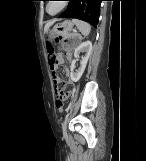 File:Acute pancreatitis - Balthazar E - post ERCP (Radiopaedia 27562-27772 Sagittal C+ portal venous phase 98).png