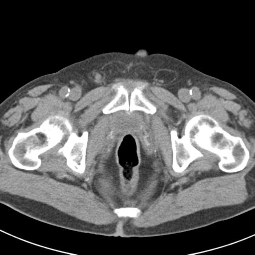 File:Acute pancreatitis and walled-off necrosis (Radiopaedia 29888-30403 Axial non-contrast 76).jpg
