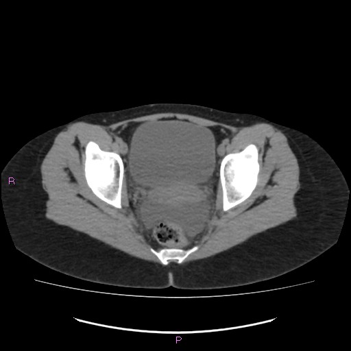 Acute pancreatitis secondary to stone at minor papilla and pancreatic divisum (Radiopaedia 76570-88333 Axial non-contrast 71).jpg