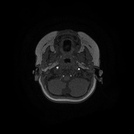 Acute phase of hemiconvulsion-hemiplegia epilepsy syndrome (Radiopaedia 29309-29745 Axial TOF angiography 144).jpg