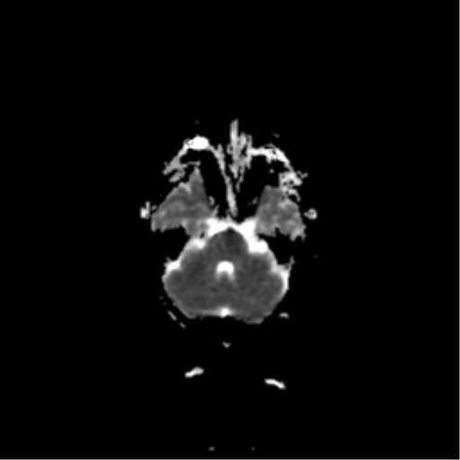 File:Acute pontine infarct from vertebral artery dissection (Radiopaedia 34111-35370 Axial ADC 6).png