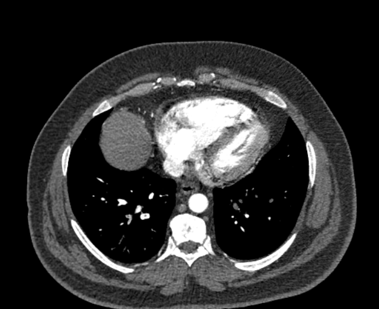 Acute pulmonary embolism with pulmonary infarcts (Radiopaedia 77688-89908 Axial C+ CTPA 47).jpg