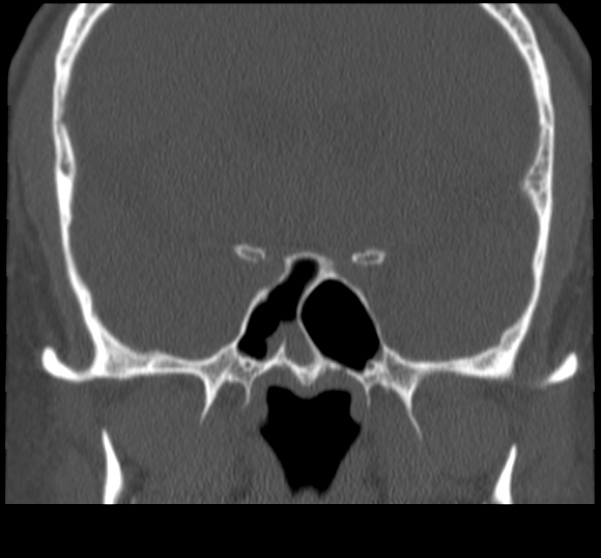 Acute sinusitis (Radiopaedia 23161-23215 Coronal bone window 50).jpg
