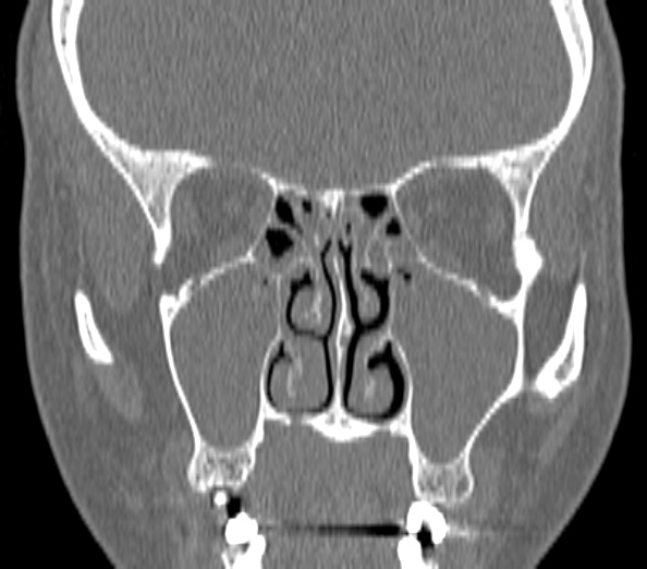 Acute sinusitis (Radiopaedia 40564-43158 Coronal bone window 22).jpg