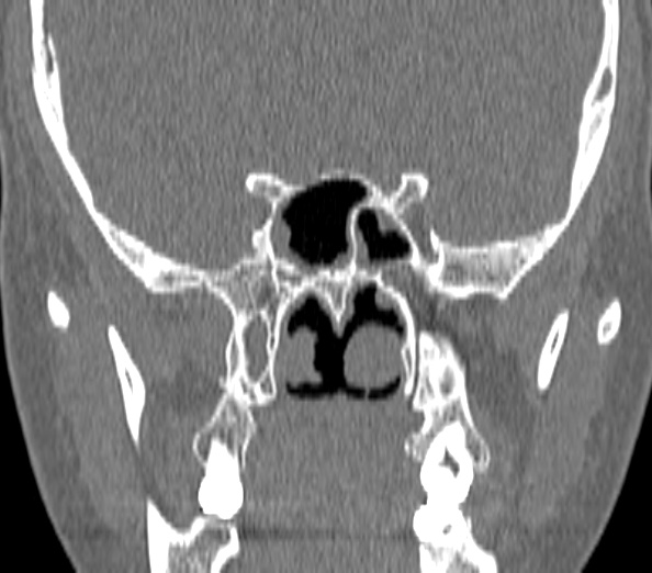 Acute sinusitis (Radiopaedia 40564-43158 Coronal bone window 34).jpg