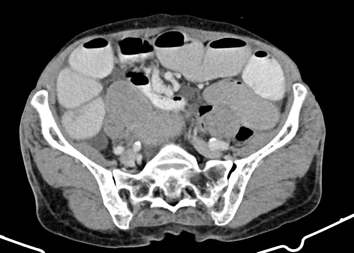 File:Acute small bowel (ileal) volvulus (Radiopaedia 71740-82139 Axial C+ portal venous phase 146).jpg