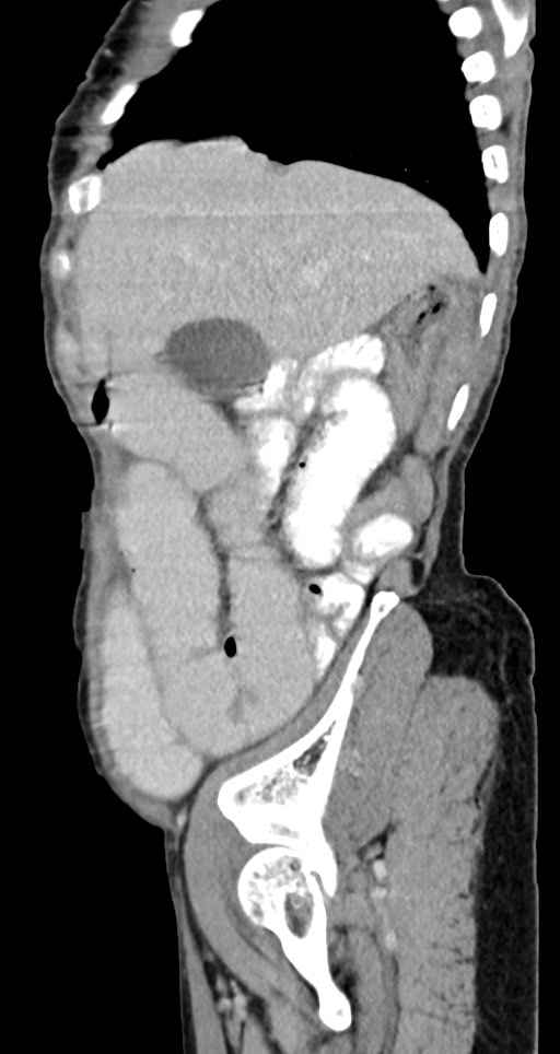Acute small bowel (ileal) volvulus (Radiopaedia 71740-82139 Sagittal C+ portal venous phase 128).jpg