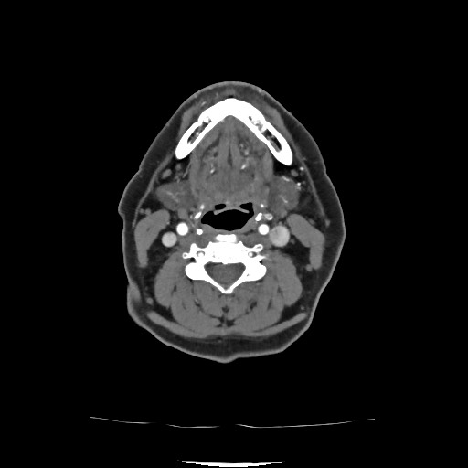 Acute subarachnoid hemorrhage and accessory anterior cerebral artery (Radiopaedia 69231-79009 Axial C+ arterial phase 52).jpg