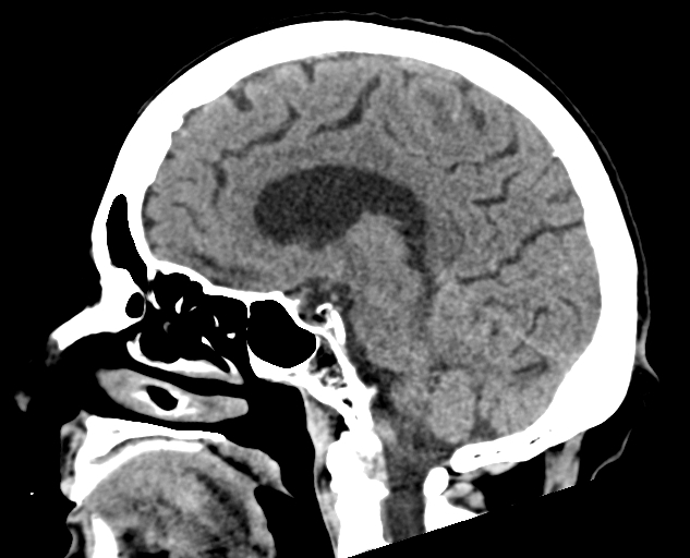 Acute traumatic subdural hematoma (Radiopaedia 82921-97257 Sagittal non-contrast 35).jpg