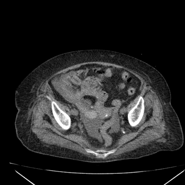 Acute tubular necrosis (Radiopaedia 28077-28334 Axial non-contrast 58).jpg