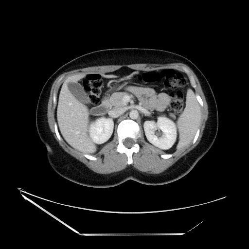 Acute uncomplicated appendicitis (Radiopaedia 73704-84499 Axial C+ portal venous phase 51).jpg