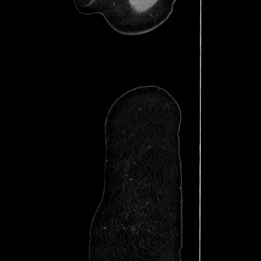 Acute uncomplicated appendicitis (Radiopaedia 73704-84499 Sagittal C+ portal venous phase 197).jpg