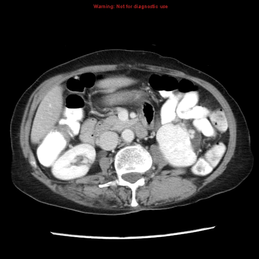Adenocarcinoma of the colon (Radiopaedia 8191-9039 Axial liver window 33).jpg