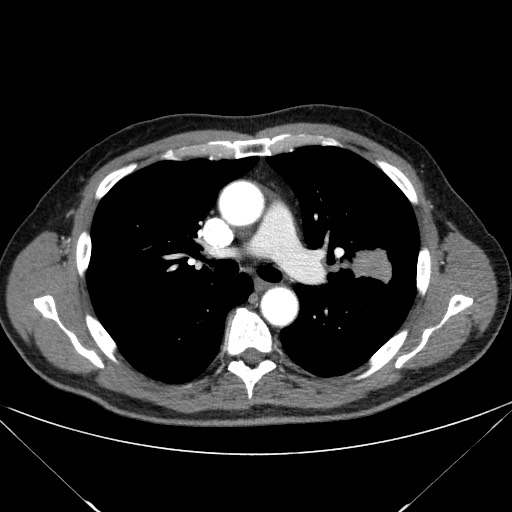 Adenocarcinoma of the lung (Radiopaedia 59871-67325 Axial C+ arterial phase 38).jpg