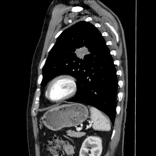 Adenocarcinoma of the lung (Radiopaedia 59871-67325 Sagittal C+ arterial phase 78).jpg