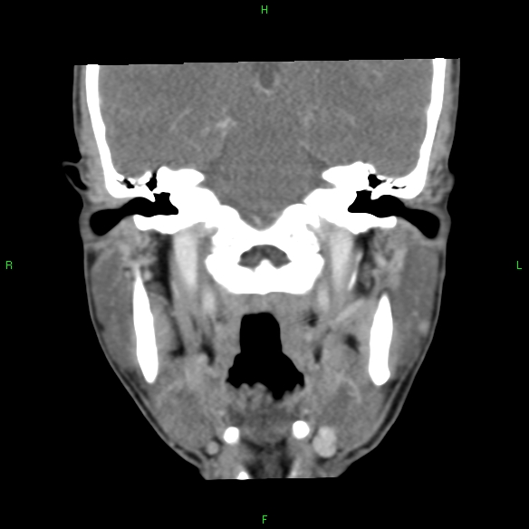 File:Adenoid cystic carcinoma of hard palate (Radiopaedia 26137-26273 Coronal liver window 23).jpg