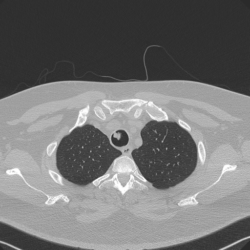 Adenoid cystic carcinoma of the trachea (Radiopaedia 49042-54137 Axial lung window 58).jpg