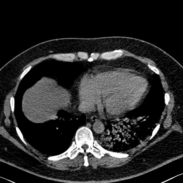 Adenoid cystic carcinoma of the trachea (Radiopaedia 49042-54137 Axial non-contrast 254).jpg