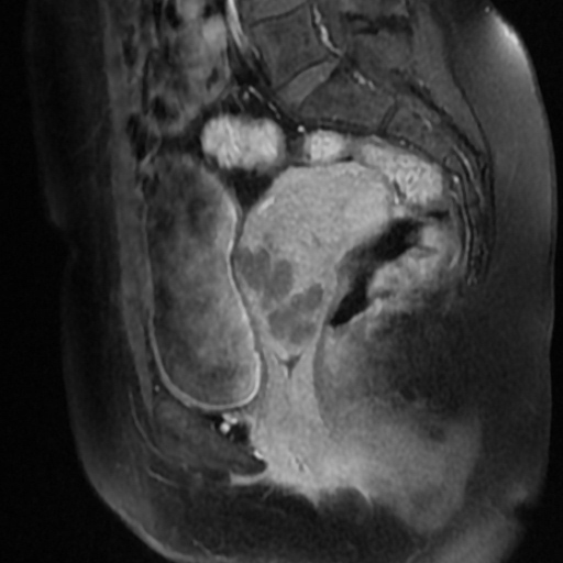 File:Adenoma malignum of cervix (Radiopaedia 66441-75705 Sagittal T1 C+ fat sat 12).jpg