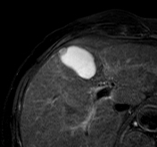 File:Adenomyomatosis of the gallbladder (Radiopaedia 14447-14386 Axial T2 fat sat 1).jpg