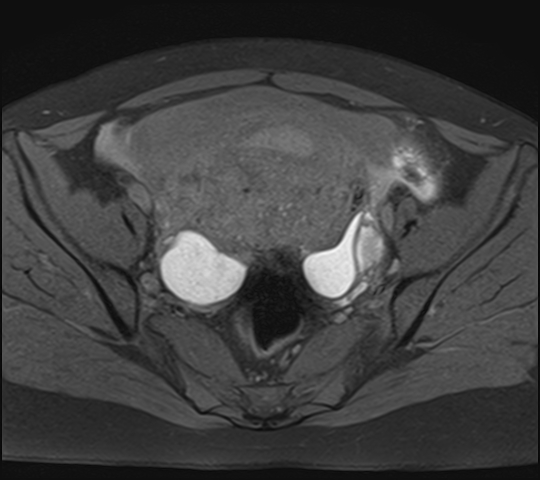 File:Adenomyosis - ovarian endometriomas (Radiopaedia 67031-76350 Axial T1 fat sat 13).jpg