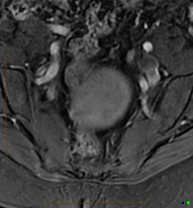 Adenomyosis uterus with hematometra (Radiopaedia 45779-50011 Axial T1 C+ fat sat 3).jpg